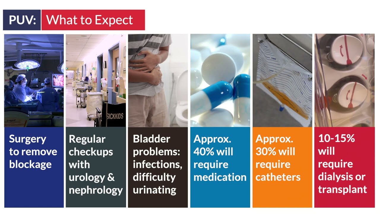 A Canadian First: Multidisciplinary Clinic for Kids with Posterior Urethral Valves