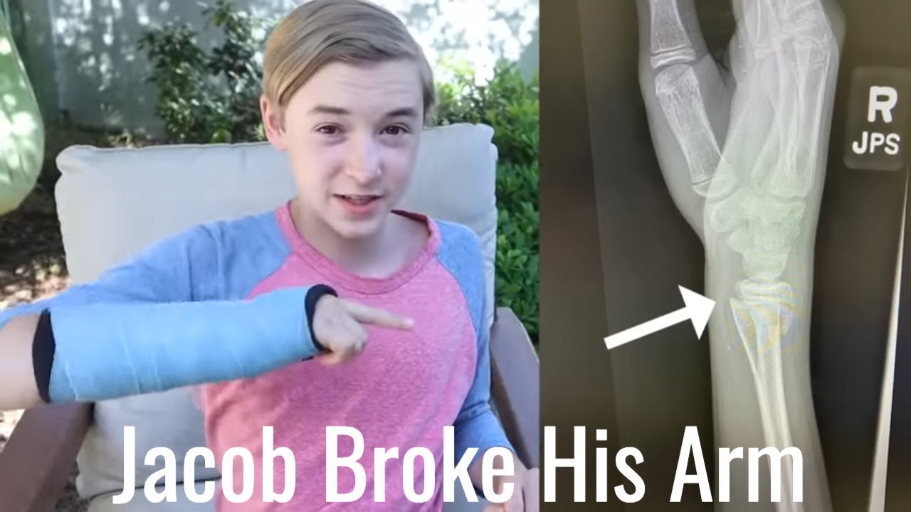 Jacob Broke His Arm