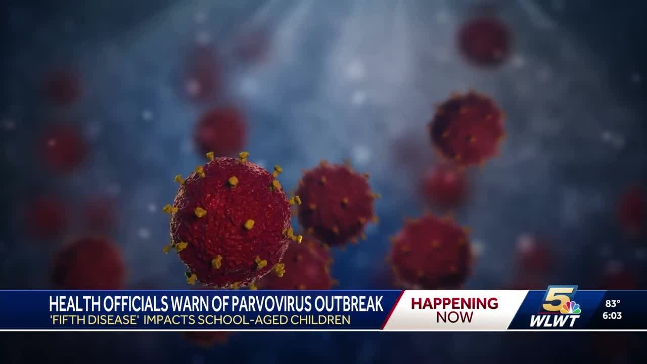 Parvovirus B19 cases rising in Hamilton County, prompting outbreak announcement