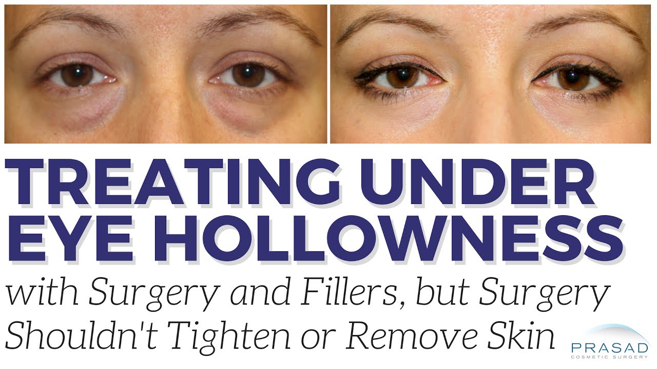 How Under Eye Hollows are Treated by Reducing Relative Depth Surgically and Non-Surgically