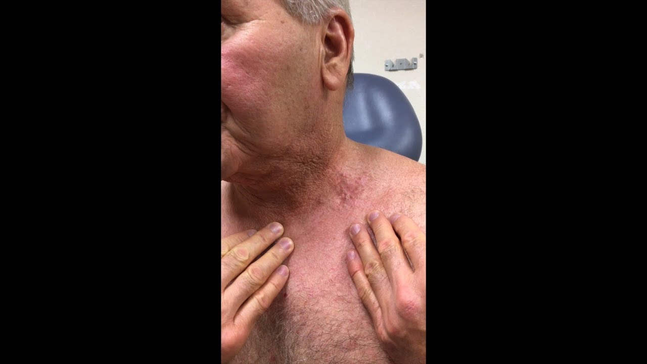 Radiation Dermatitis With Microneedle Fractional Radiofrequency: A Patient Testimonial