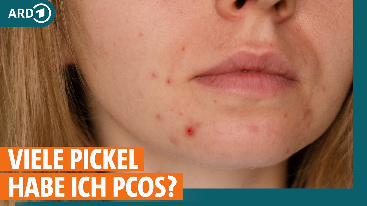 PCOS - Was ist PCOS, Symptome und Behandlung I ARD Gesund