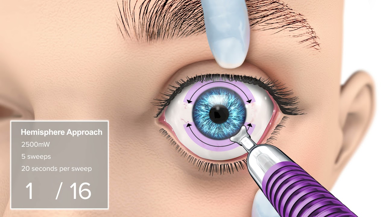 MicroPulse TLT with MicroPulse P3 Probe: Hemisphere Approach