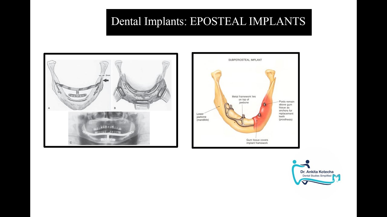 4. EPOSTEAL IMPLANTS| TYPES OF DENTAL IMPLANTS| DR. ANKITA KOTECHA| DENTAL STUDIES SIMPLIFIED