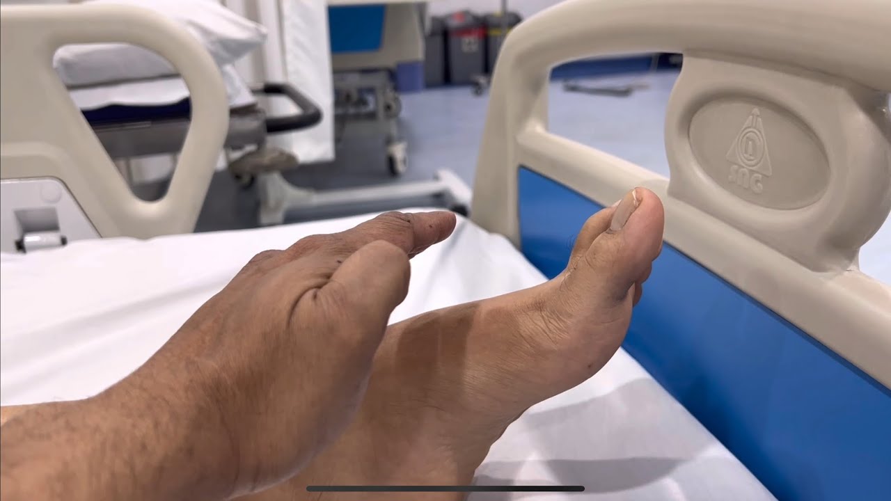 FOOT DROP 30 yrs old RECOVERY video after Surgery