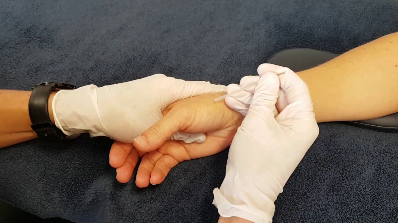 Trigger point dry needling TDN of the Thumb