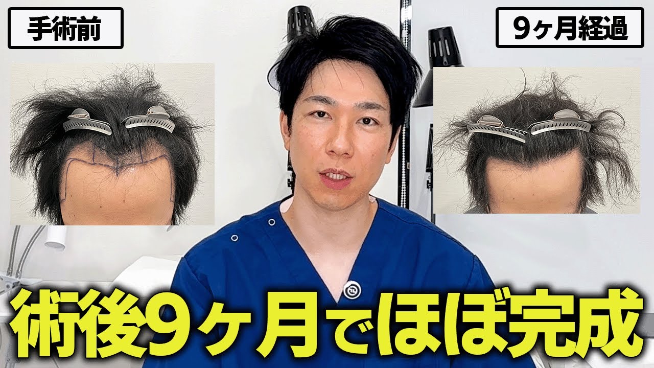 植毛手術9ヶ月目の心境「いろいろと諦めていたが、今は...」｜2000株の30代男性の経過