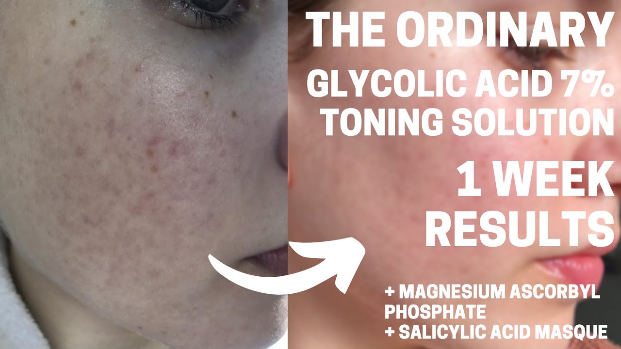 I Tried The Ordinary Glycolic Acid 7% Toning Solution Every Day For One Week (+more) | HONEST REVIEW