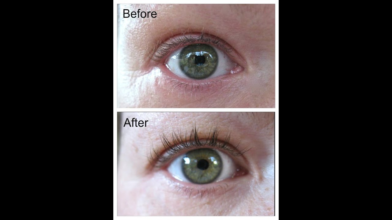 Careprost (Latisse) Before & After. NO MASCARA