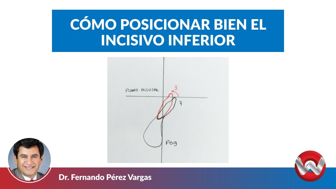 Como posicionar bien el incisivo inferior