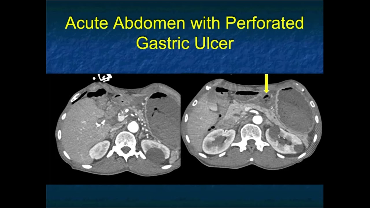 CT of the Acute Abdomen: GI Applications - Part 1