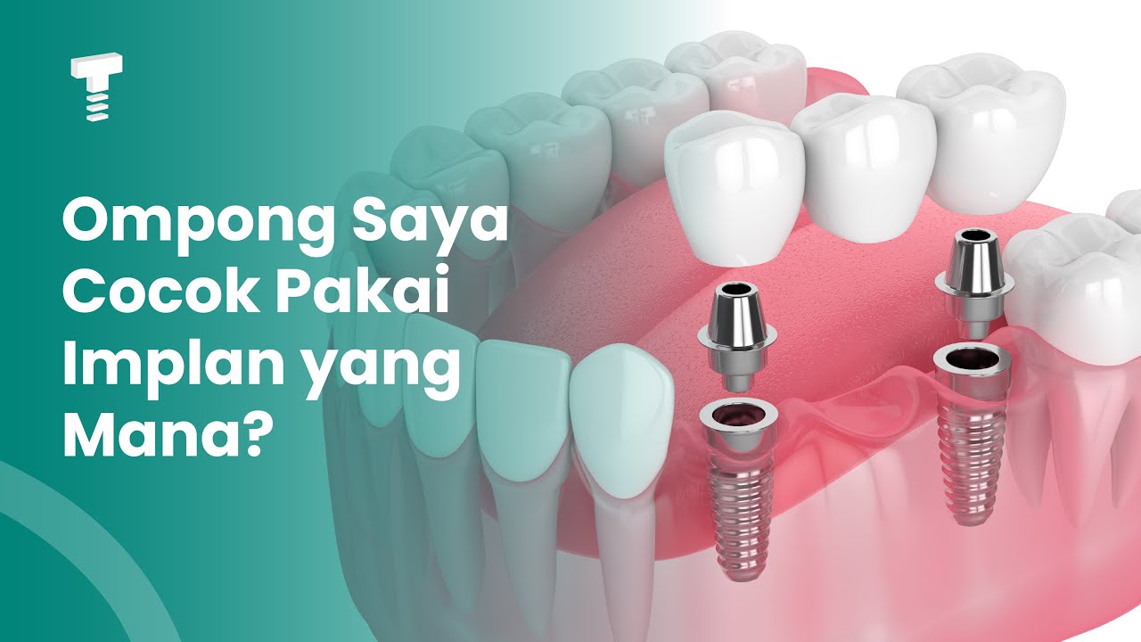 Jenis Implan Gigi di Tanam dan Perbedaannya