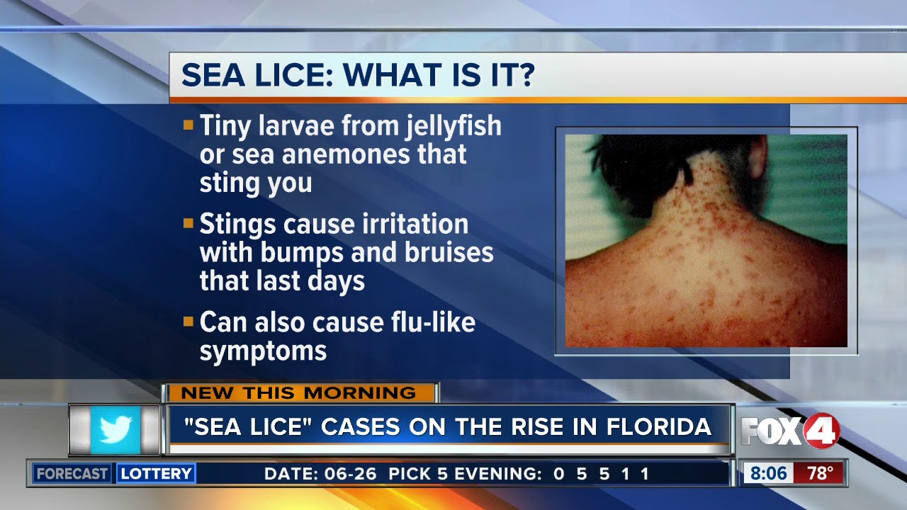 Sea lice reported along Florida beaches