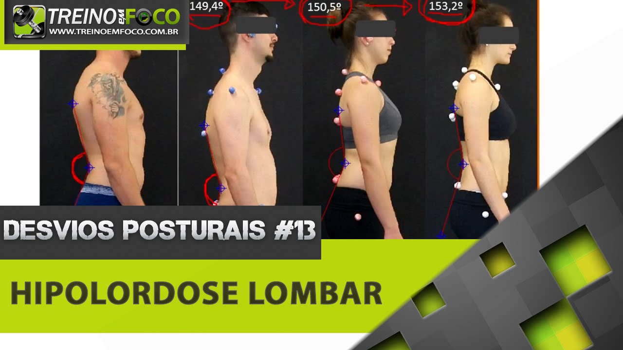 Hipolordose Lombar - Desvios Posturais #13