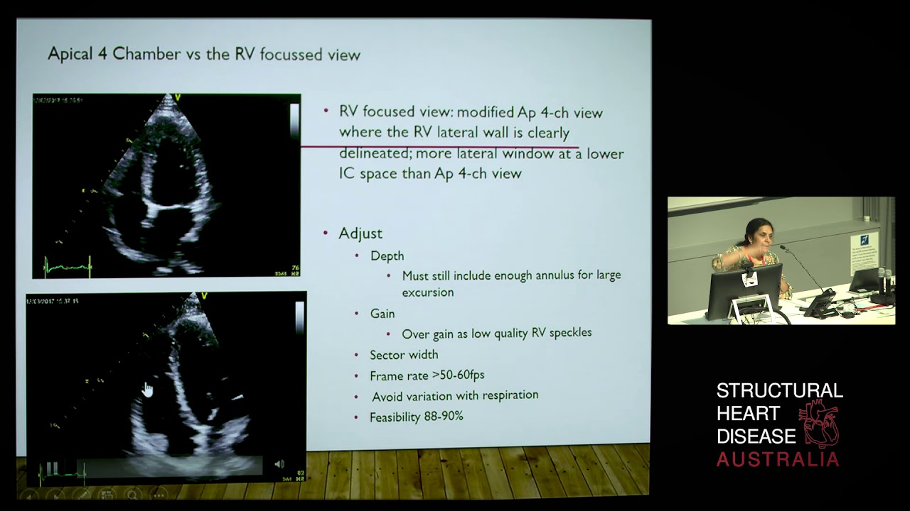 Right Ventricular Assessment: Move Over RV S' & TAPSE, Strain all the Way – Prof Liza Thomas