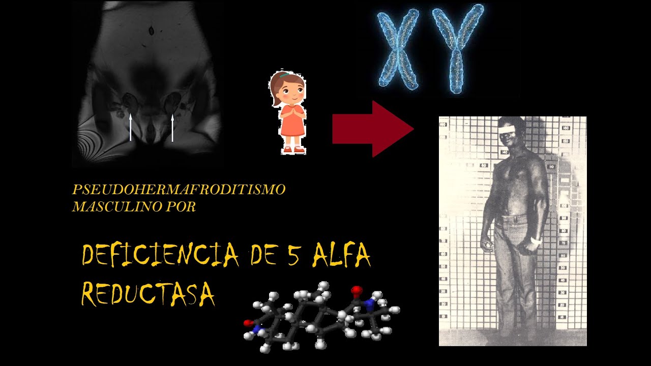 Pseudohermafroditismo masculino por Deficiencia de 5 alfa Reductasa