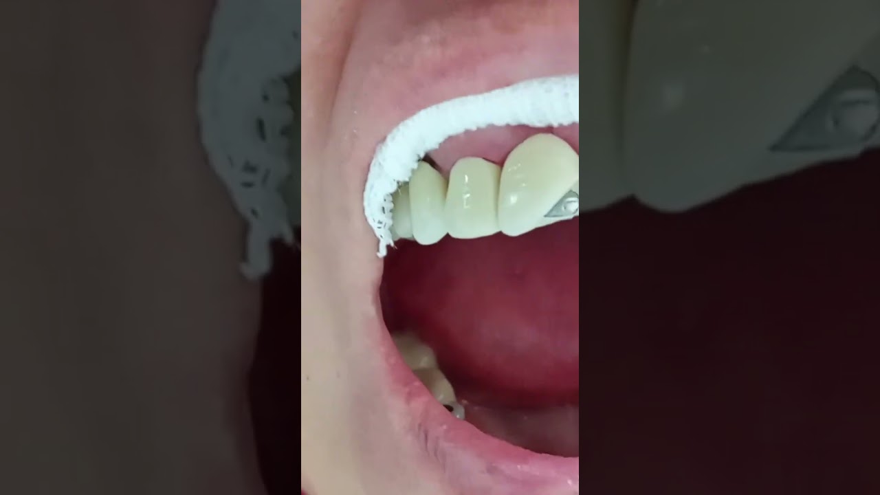 fractura puente metal porcelana. Compostura provincial en acrílico