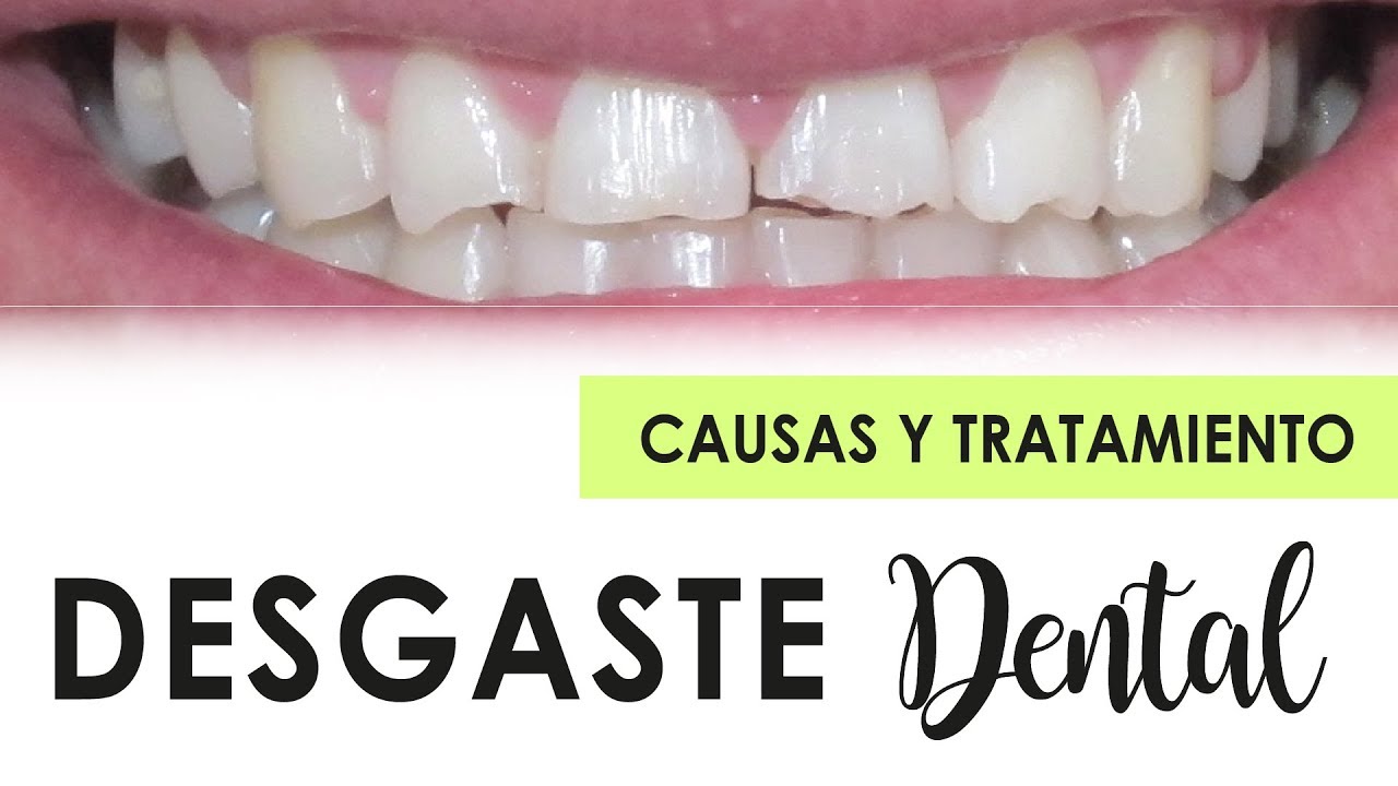DESGASTE DENTAL: CAUSAS Y TRATAMIENTOS