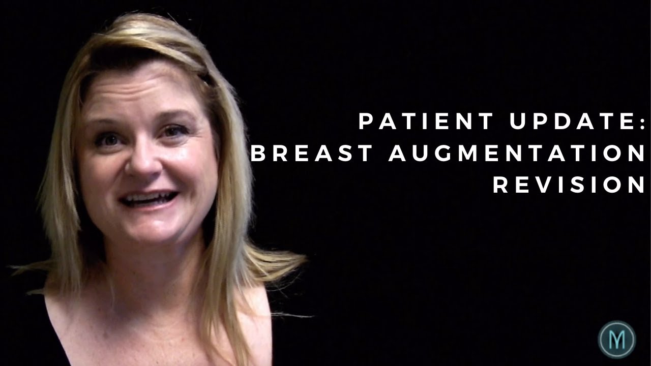 MY BREAST IMPLANT STORY: Patient Gives An Update On Her Breast Aug In Beverly Hills by Dr. Motykie