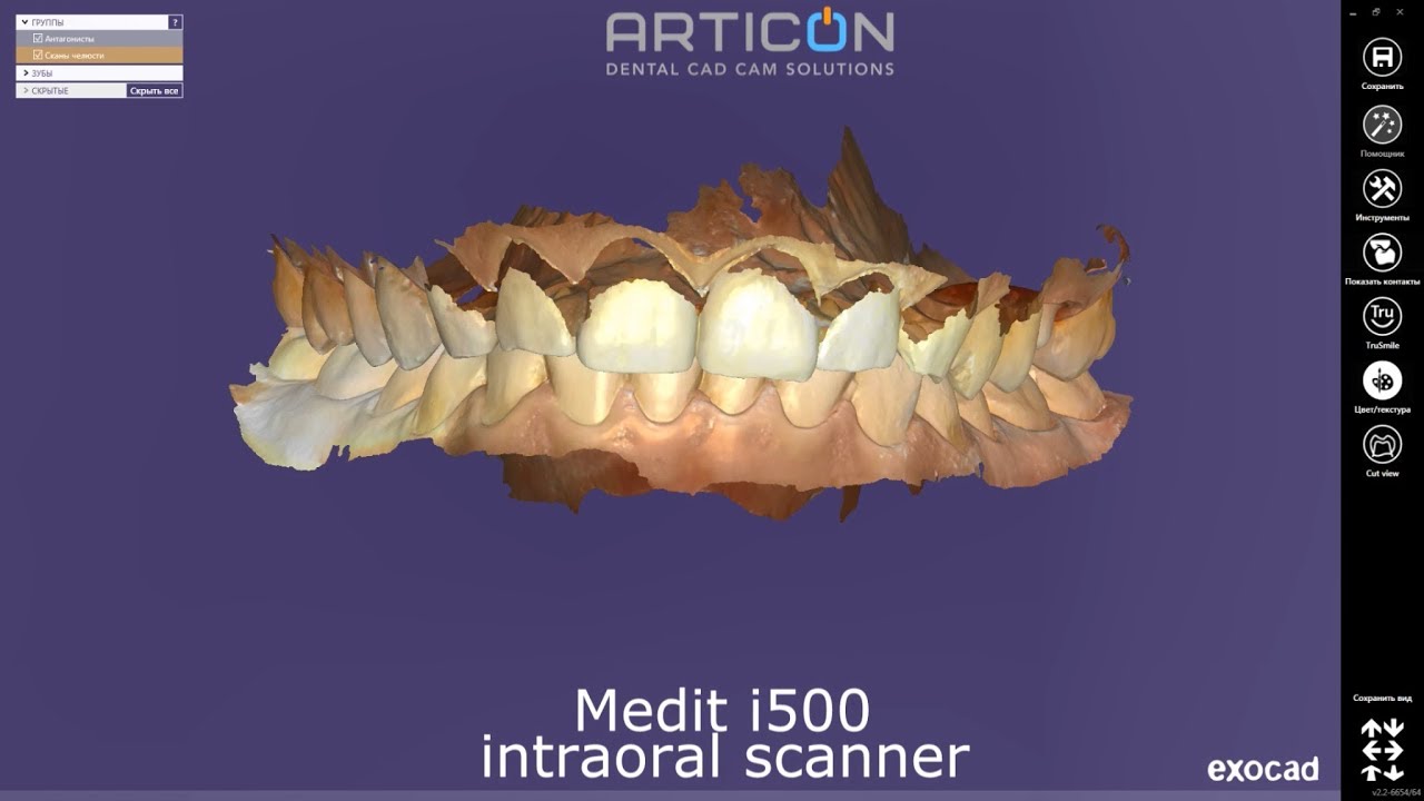 Exocad + Medit i500 intraoral scanner: single crown case