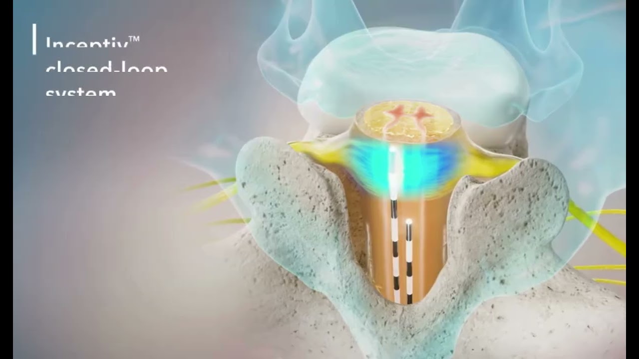 Medtronic Inceptive Closed Loop Spinal Cord Stimulation