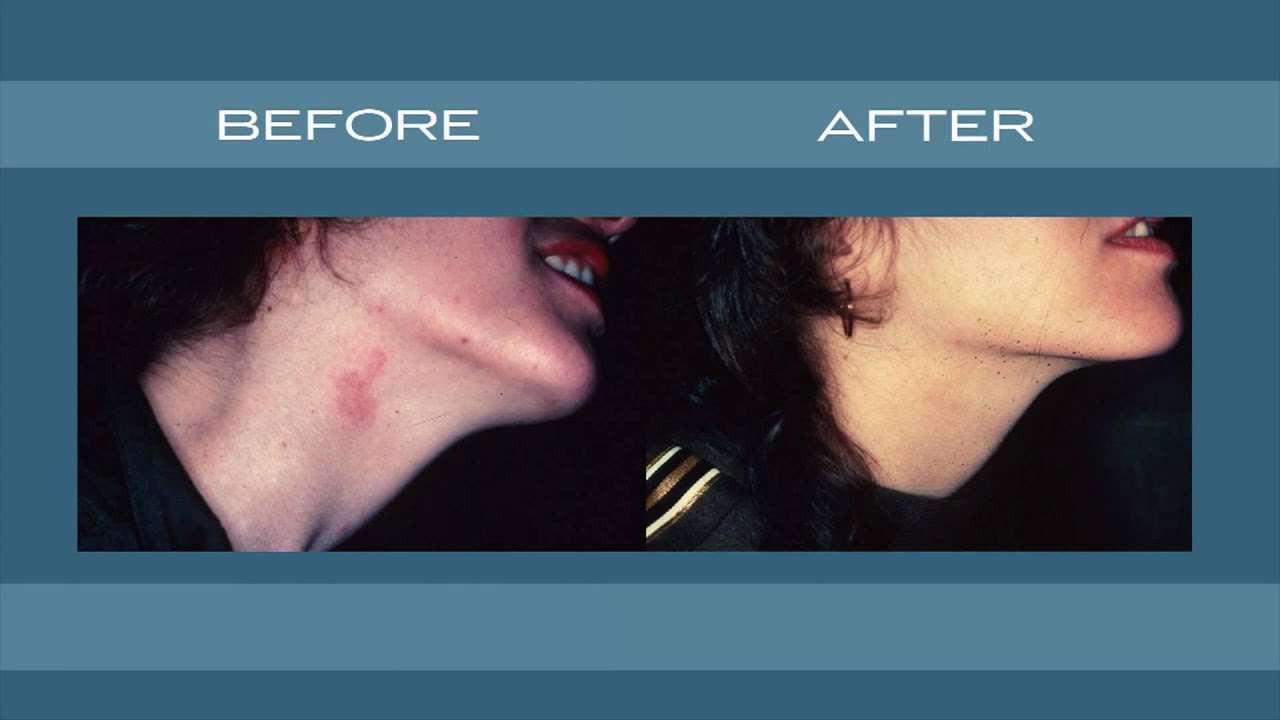 Skin Laser & Surgery Specialists - Port Wine Stain Birthmark Removal - New York & New Jersey