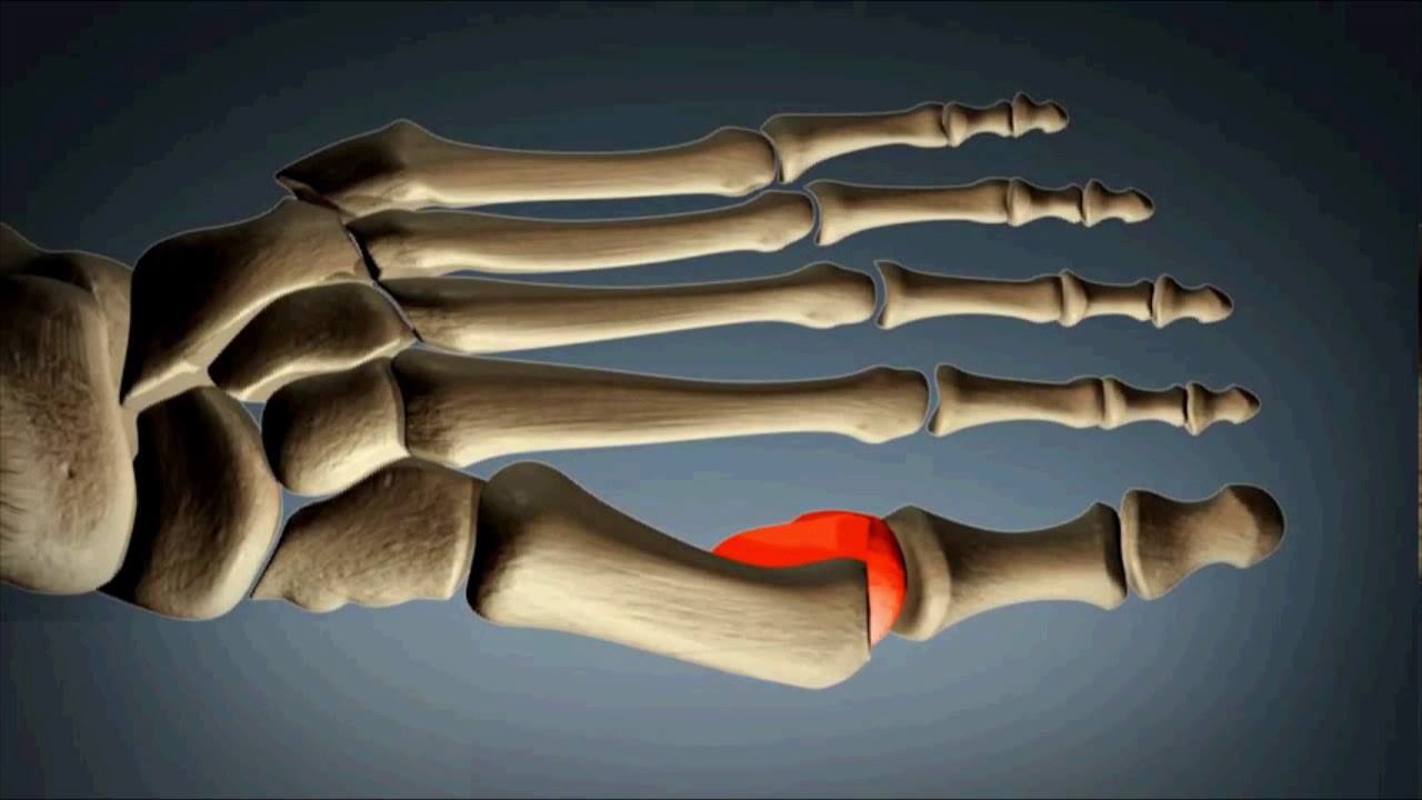 La chirurgie mini invasive de l'hallux valgus