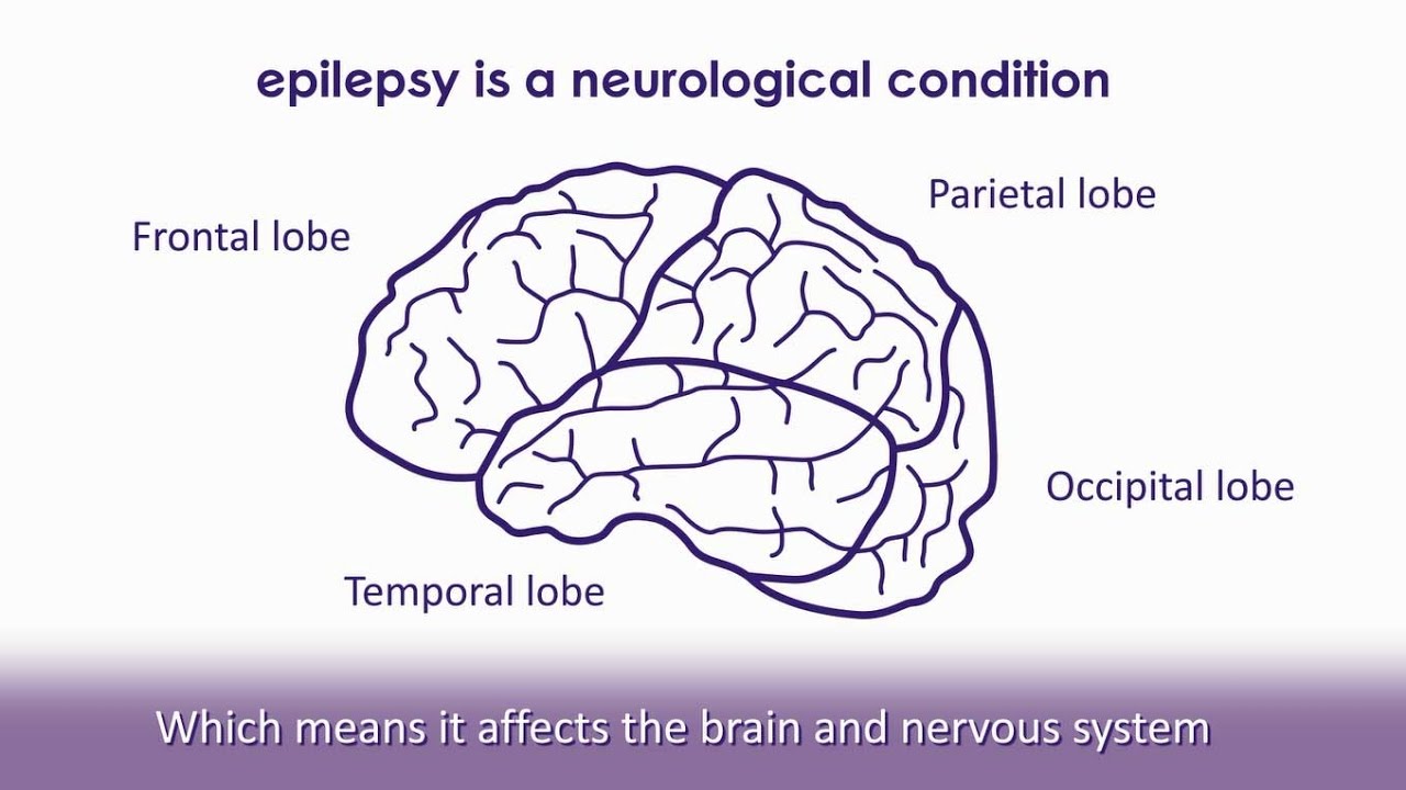 What is epilepsy? | Epilepsy Society