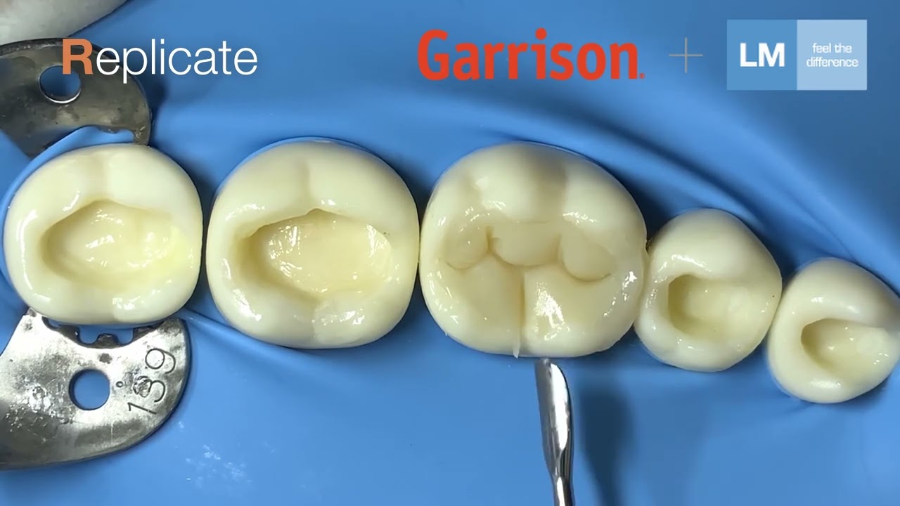 LM-Arte™ Replica Posterior makes occlusal modeling fast, simple and predictable