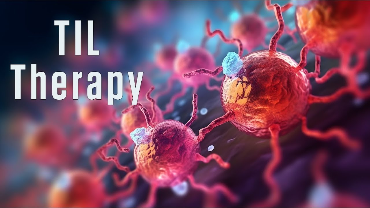 TIL Therapy at Roswell Park — The First Cellular Therapy for Solid Tumors