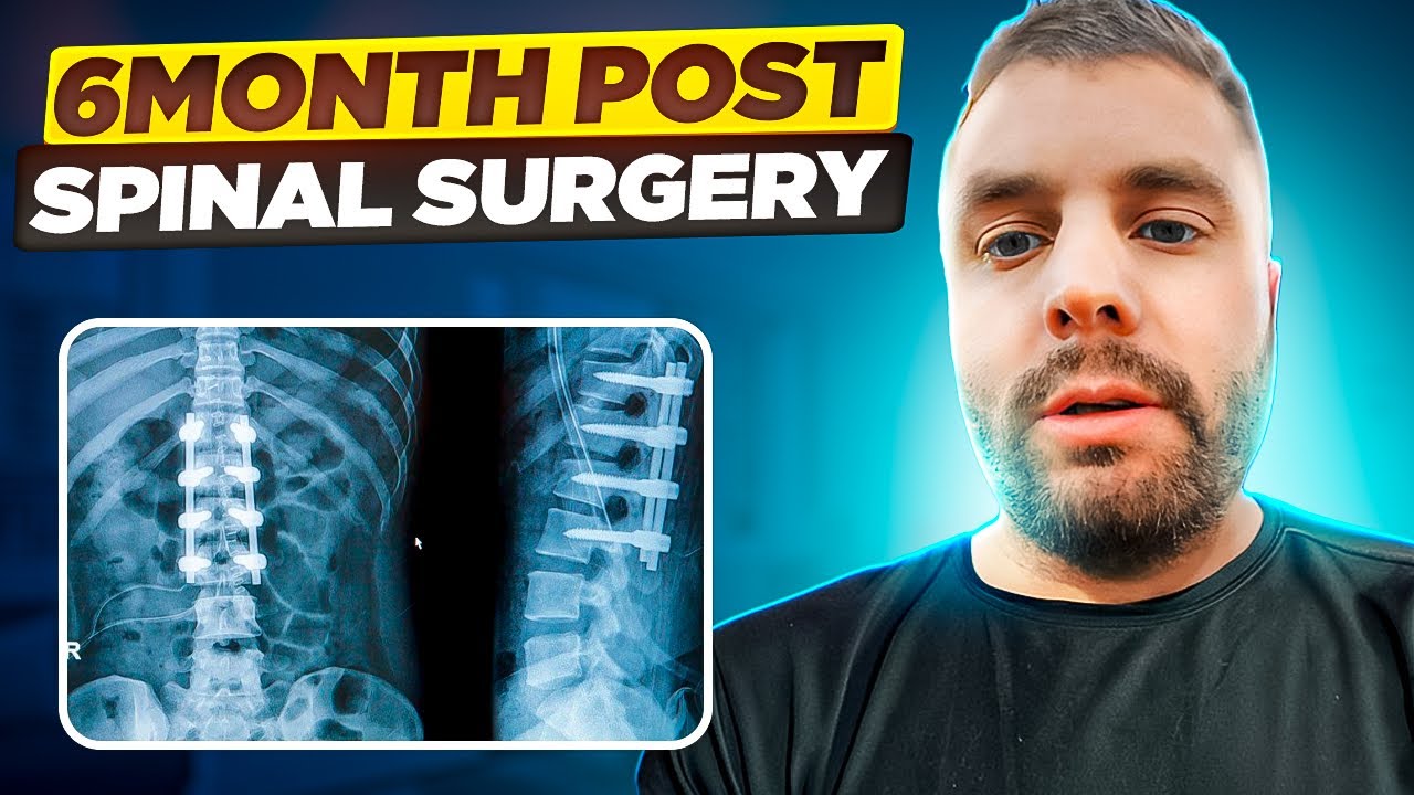 Overcoming the Odds: My Inspiring Back Pain Recovery after Surgery