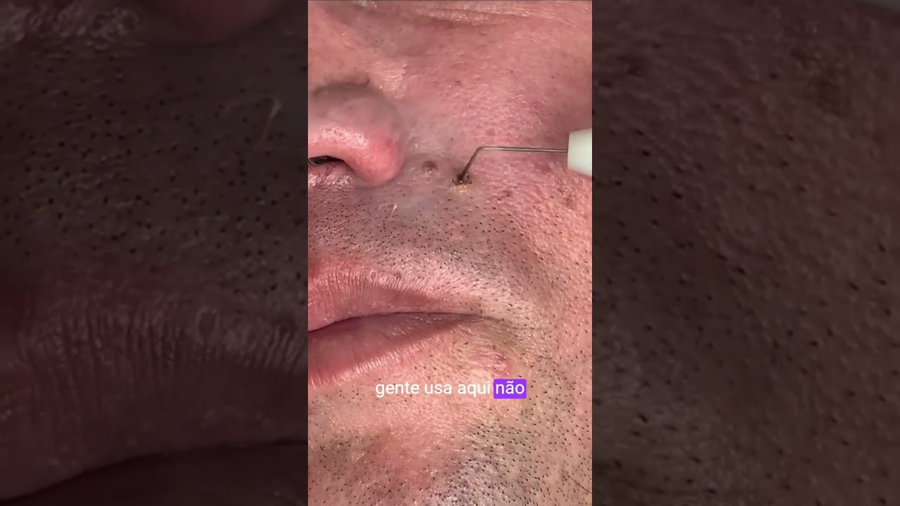 Remoção de Pintas com Plasma