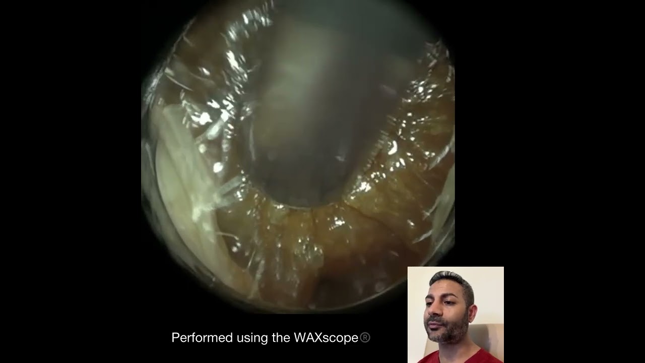 458 - Удаление липкой, застрявшей в ухе серы с помощью WAXscope&reg;