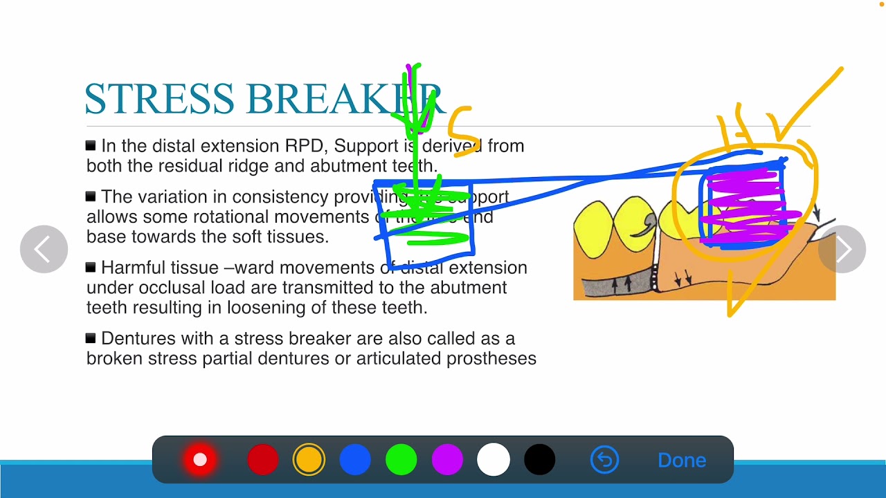 3-14 Prosthodontics, Stress Breaker - Stress Equalizer.