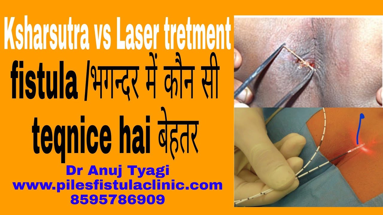 fistula / भगन्दर में कौन सी teqnice बढ़िया हैं..Ksharsutra vs Laser surgery comparison