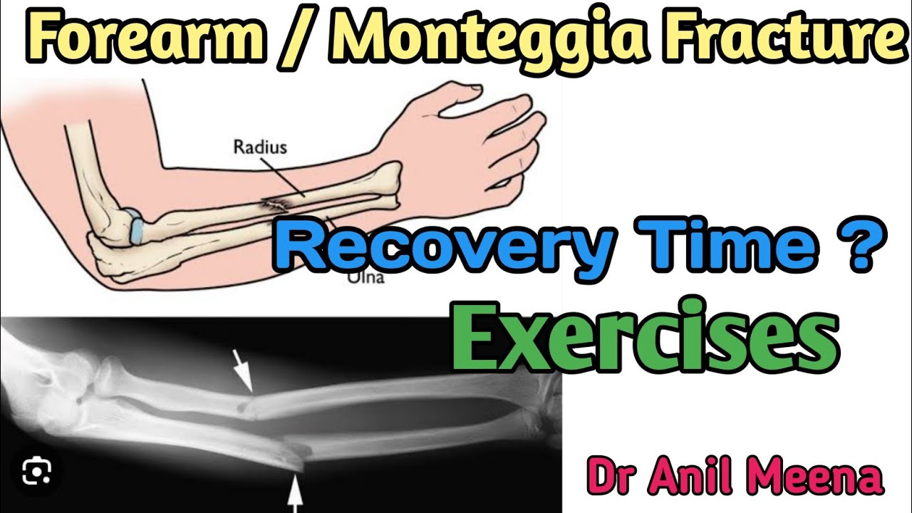 forearm fracture recovery time |Monteggia fracture recovery time | forearm fracture | in hindi