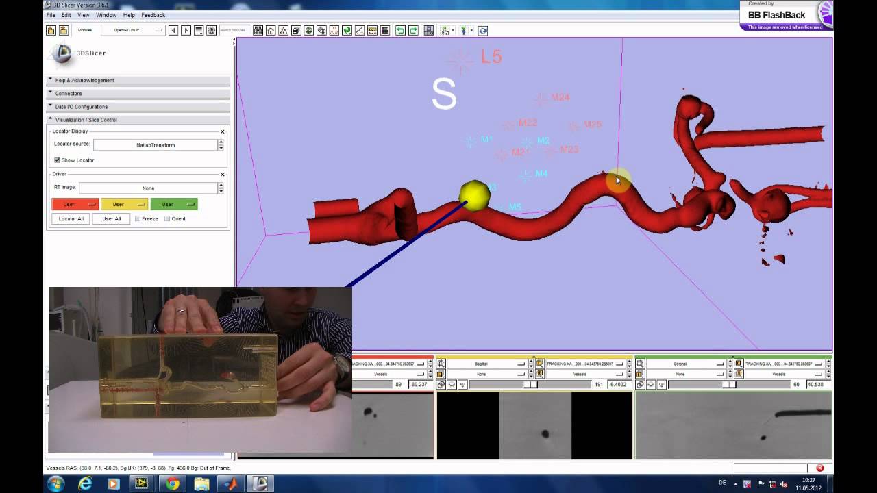 Guiding neurovascular catheter using electromagnetic tracking system