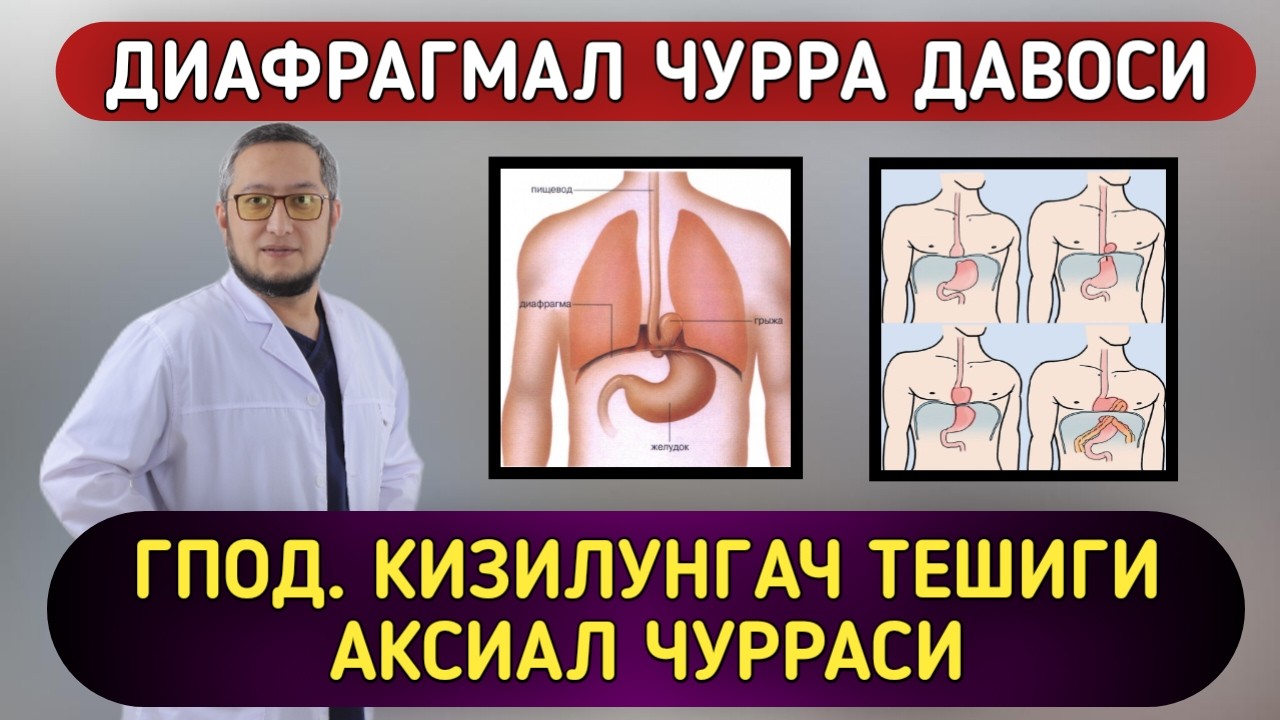 ДИАФРАГМАЛ ЧУРРА ДАВОСИ. ГПОД. КИЗИЛУНГАЧ ТЕШИГИ АКСИАЛ ЧУРРАСИ