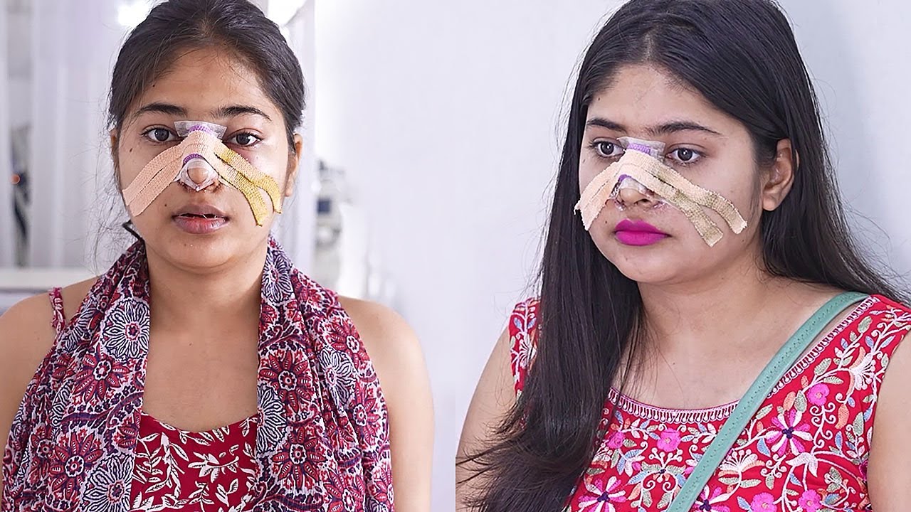 Rhinoplasty - Nose Job Before & After Surgery | Rhinoplasty in India