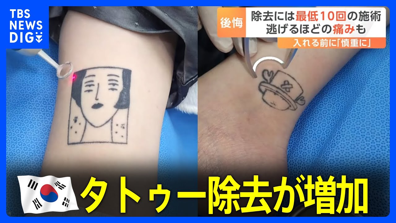 “痛みで逃げ出す人も” 韓国でタトゥー除去が増加　その背景に社会の変化 人口の4分の1がタトゥーを入れたとの推計｜TBS NEWS DIG