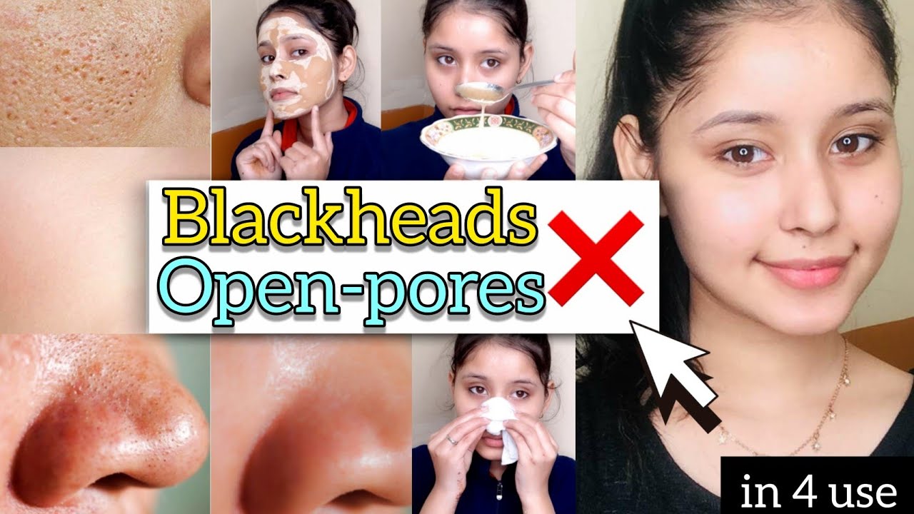 4 USE CHALLENGE😍 -No More Blackheads-Whiteheads-Open Pores |DEEP CLEANSING|100%👍 |KiranTutorialz