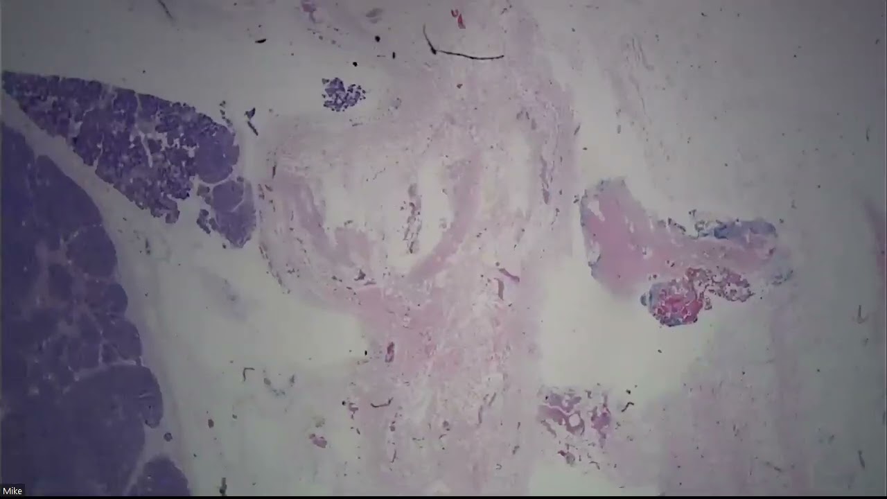 ENT Salivary Frozens Day 3 2023 03 06