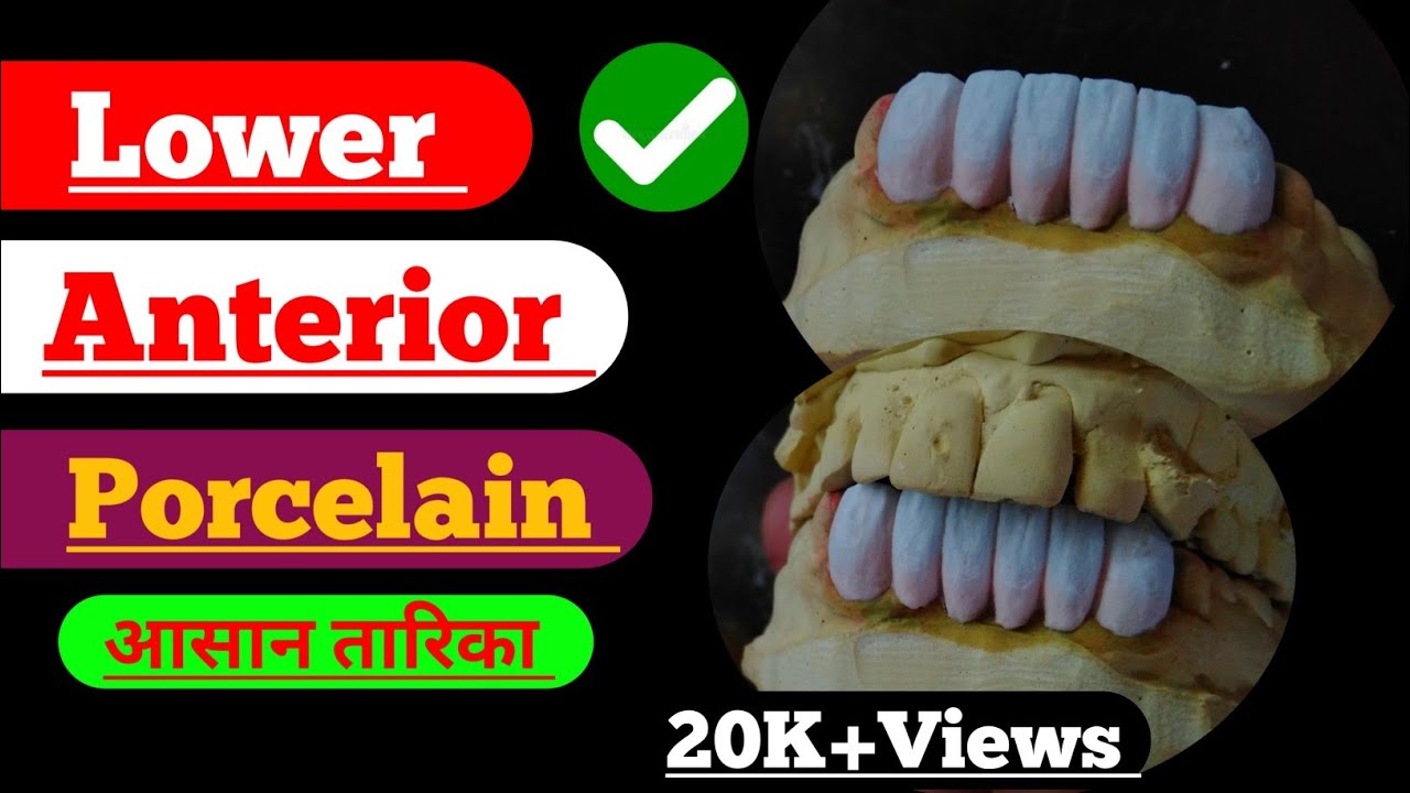 Lower Anterior Porcelain|  6 unit Anterior Build up| ceramic build up| Anatomy| Laboratory| Build up
