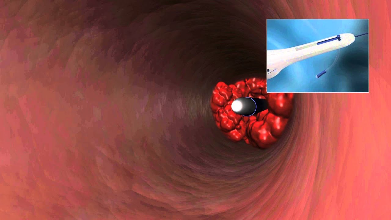 CLEANER15 Rotational Thrombectomy System