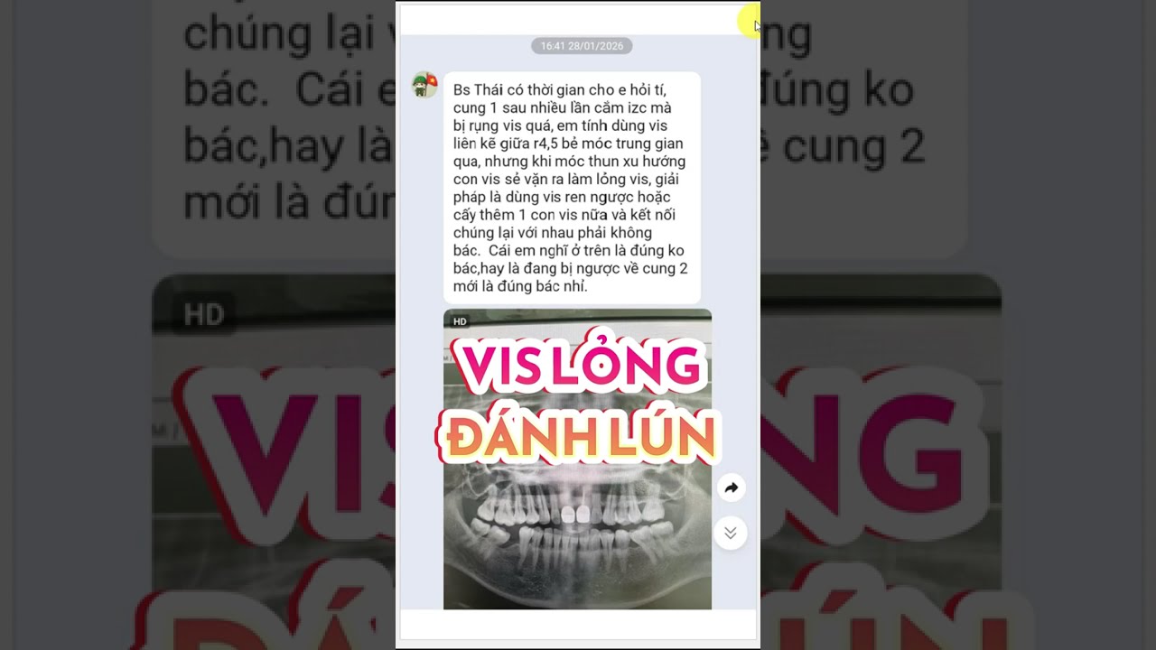 Vis đánh lún răng cối bị lỏng ra: Giải pháp là gì? #drthaiortho #learnortho