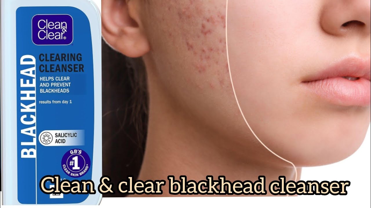 Honest review about clean and clear blackhead cleanser #blackhead #pimple #skincare