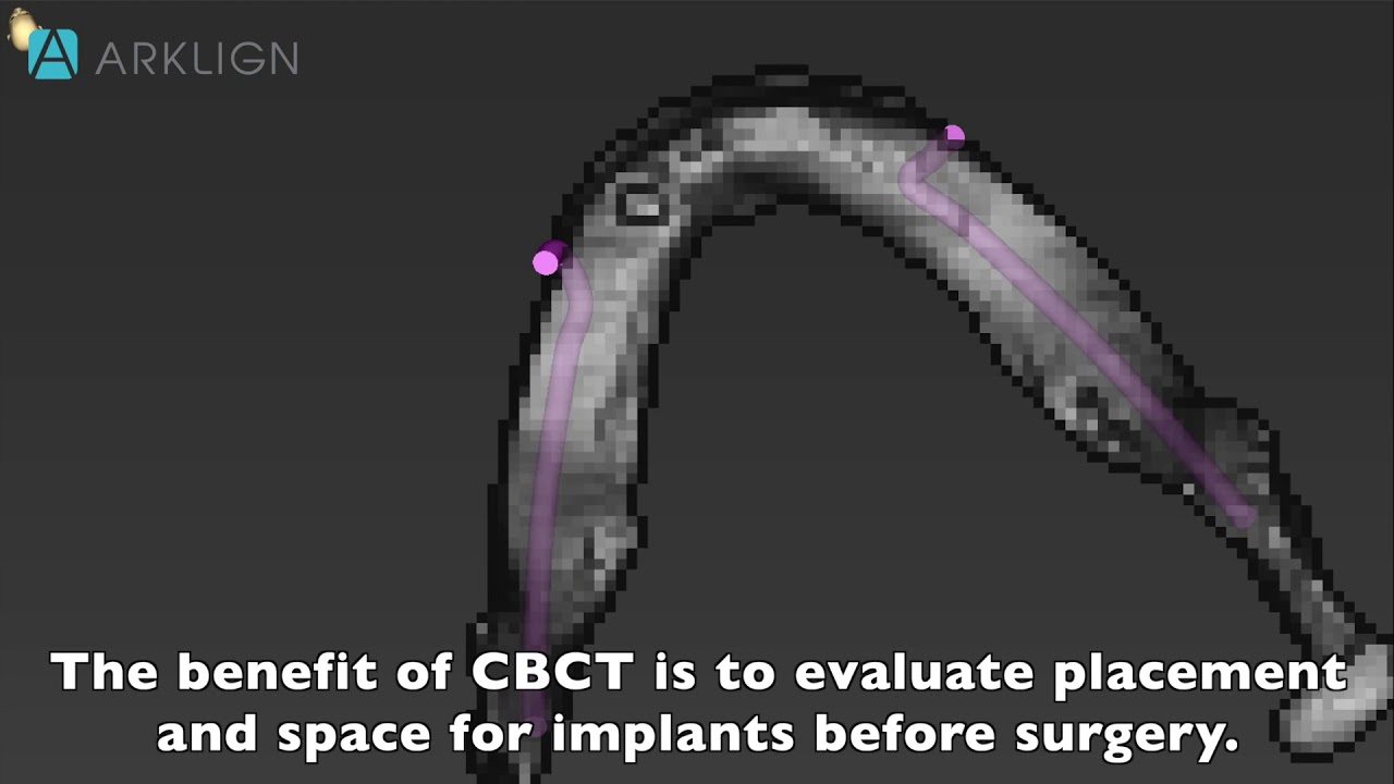 Motion artifacts in CBCT