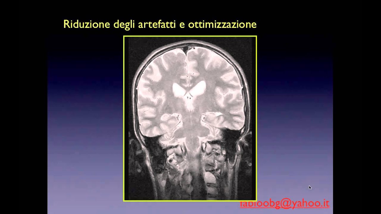 Artefatti in RM