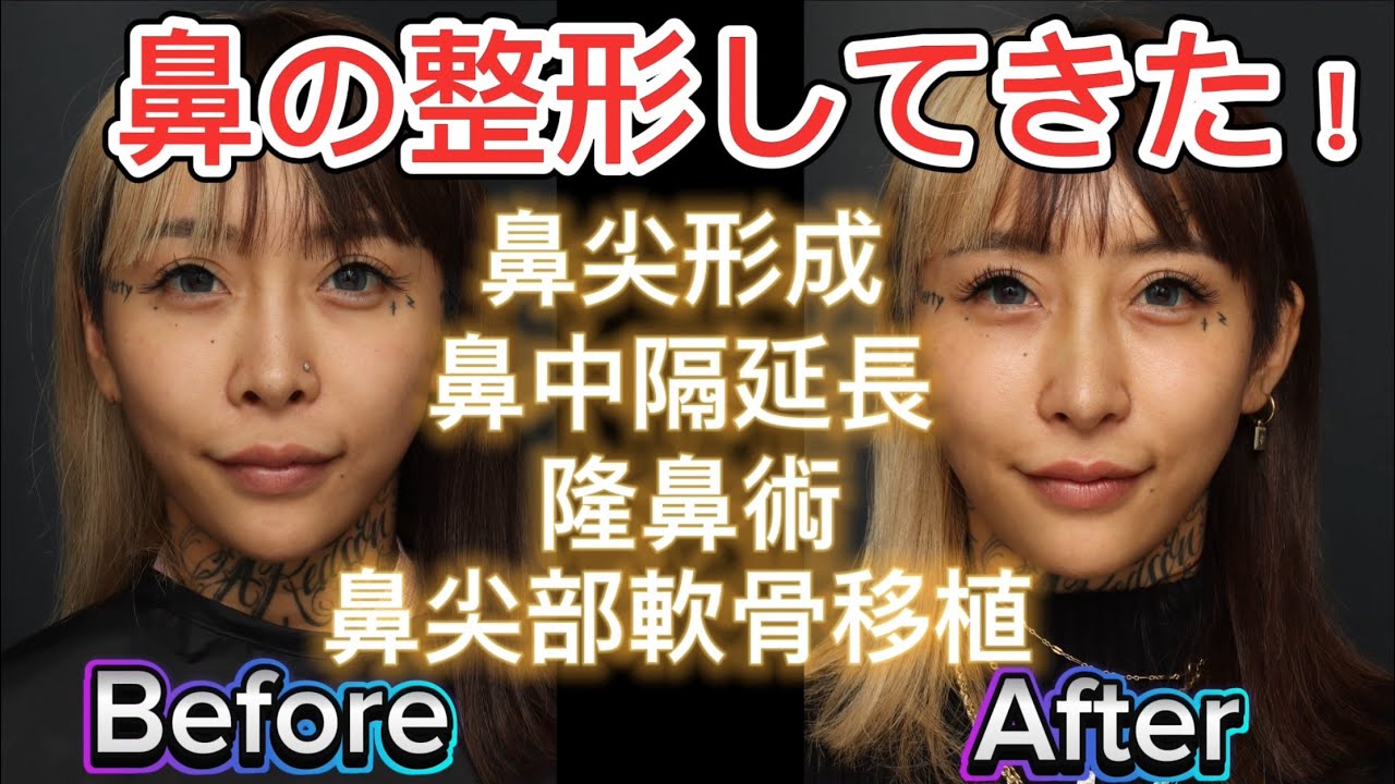 【整形】ついに鼻の整形してきた！ダウンタイムまで全て見せます！