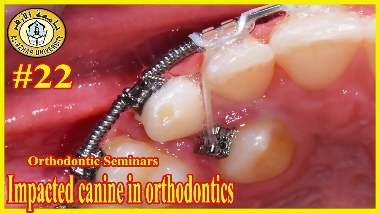 #22 Impacted canine in orthodontics سيمينارات تقويم الأسنان جامعة الأزهر